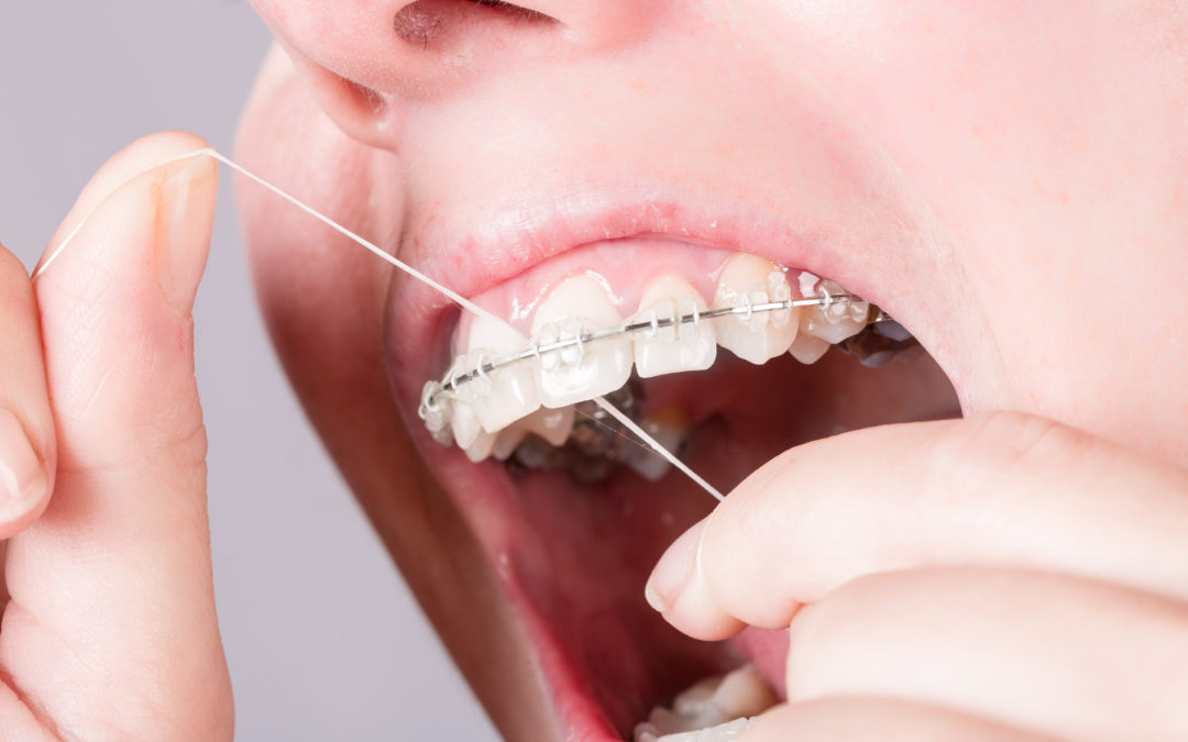 Prevent Plaque Buildup with Proper Oral Hygiene While Wearing Braces