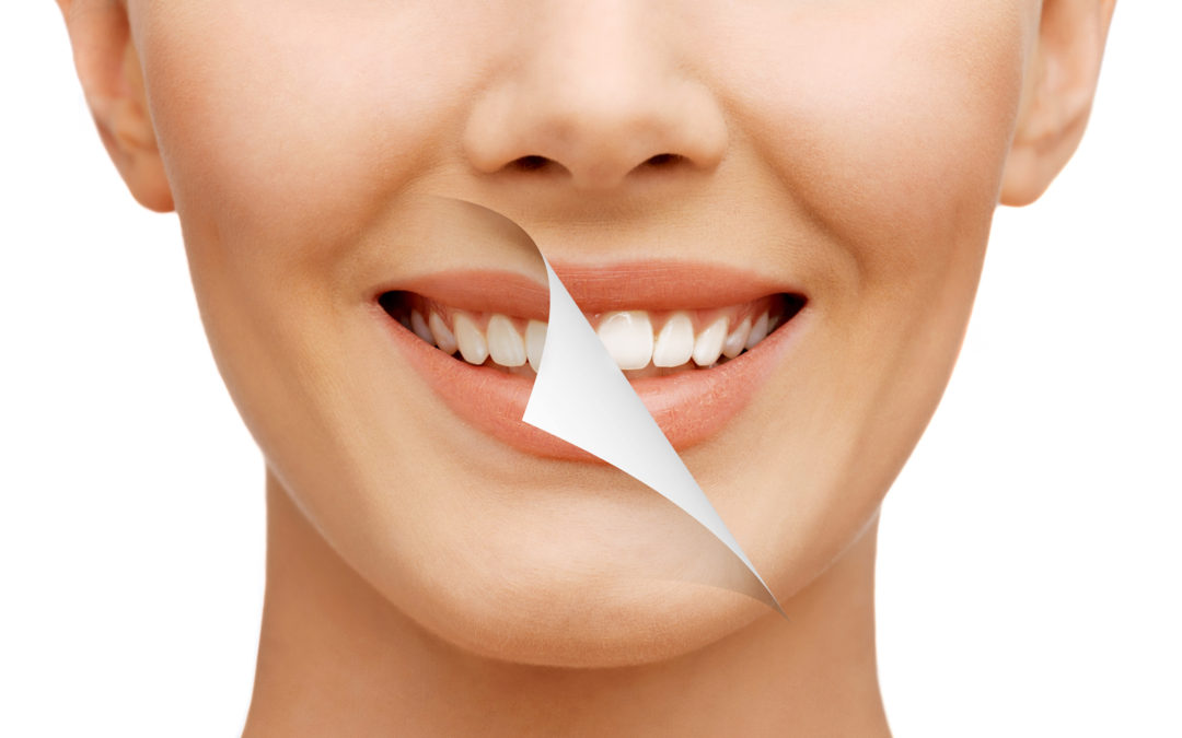 Dangerous Teeth Whitening Practices Promoted on Social Media